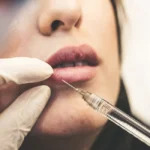 Tips On How To Responsibly Use Botox On Your Face
